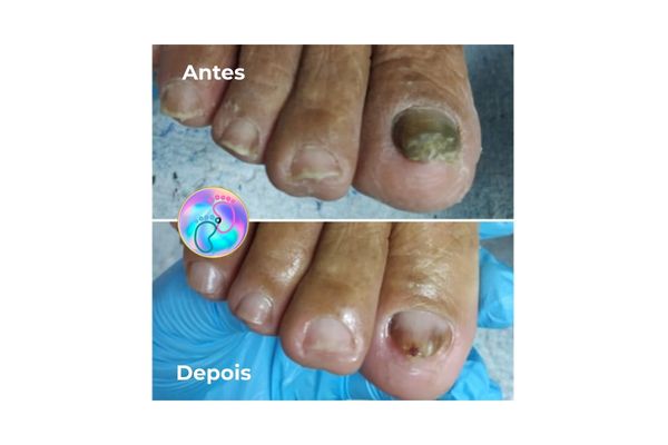 Foto de antes e depois do tratamento 42